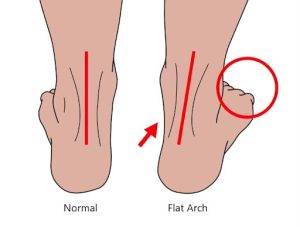 Are You Walking on Flat Feet? 3 Tests to Check | EastWest Physio