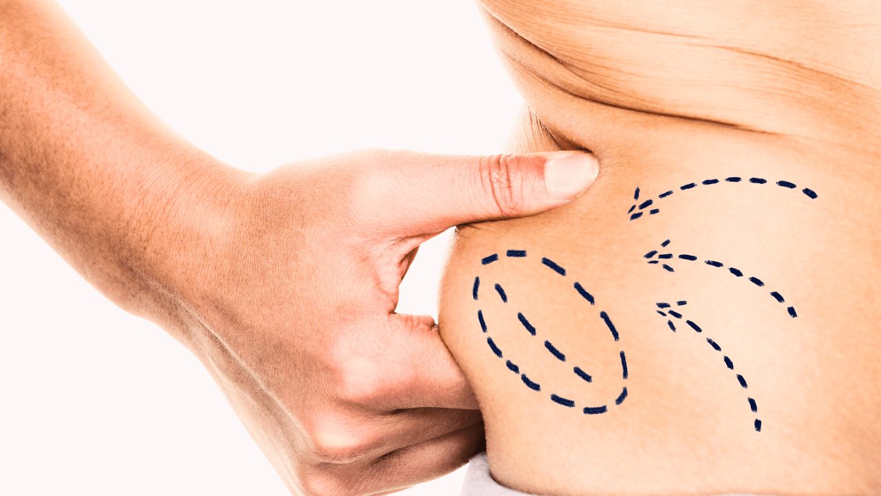 Post-Liposuction Care