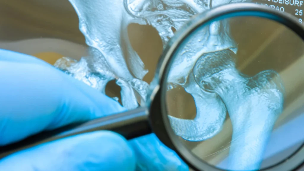 Hip Xray Burnaby Physiotherapy